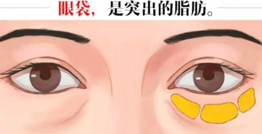 眼袋