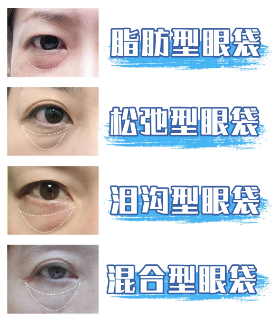 眼袋