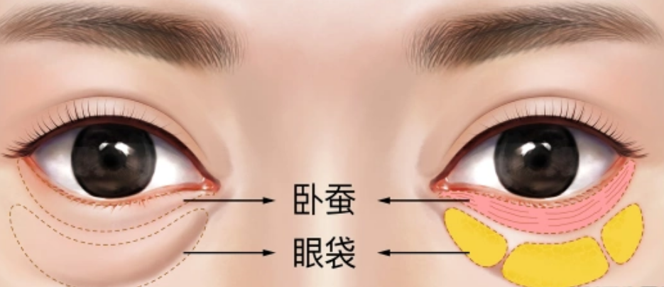 眼袋
