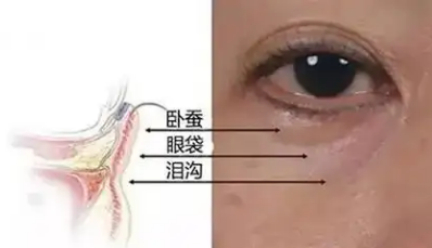 眼袋