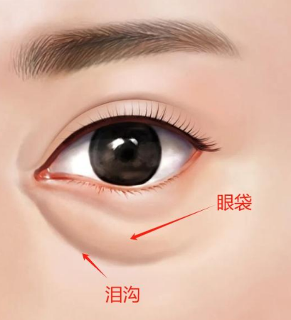眼袋