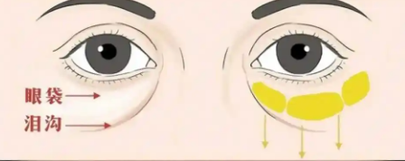 眼袋