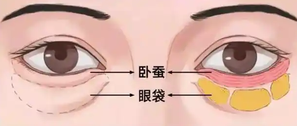 去眼袋手术