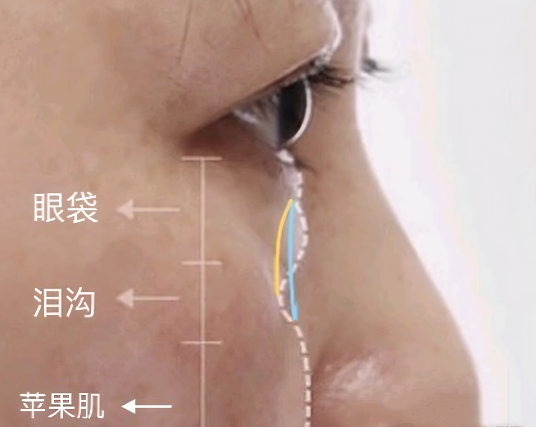去眼袋手术