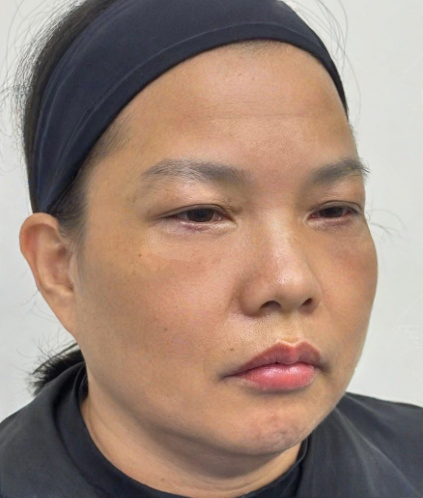 去眼袋手术