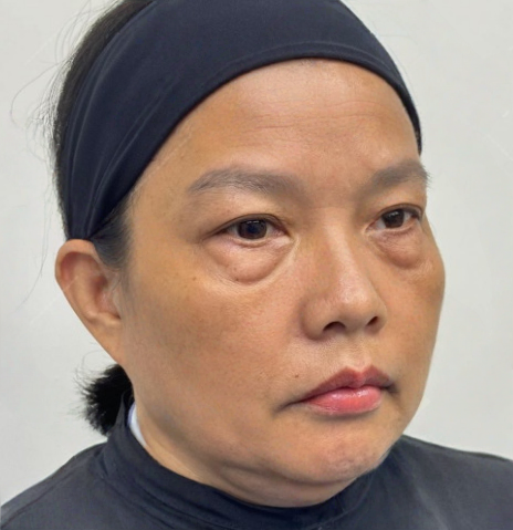 去眼袋手术