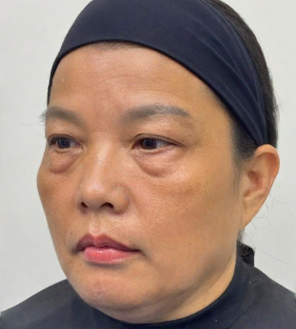 去眼袋手术