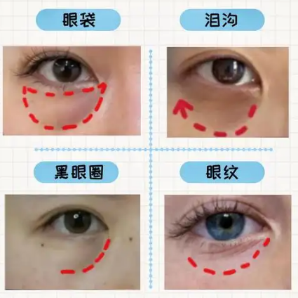 去眼袋手术