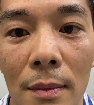 去眼袋手术