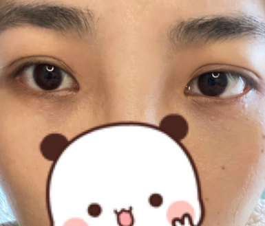 去眼袋手术