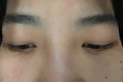 去眼袋手术