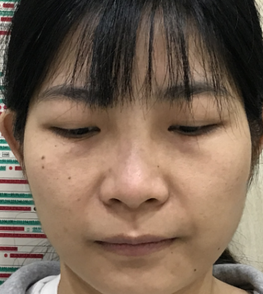 去眼袋手术