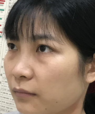 去眼袋手术