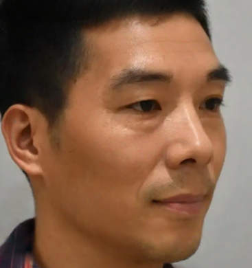去眼袋手术