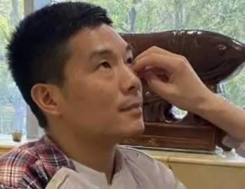 去眼袋手术