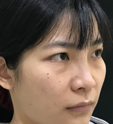 去眼袋手术
