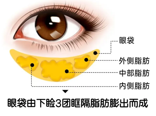 去眼袋手术