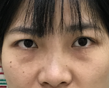 去眼袋手术