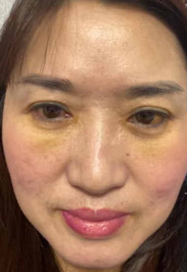 去眼袋手术