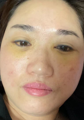 去眼袋手术
