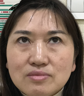 去眼袋手术