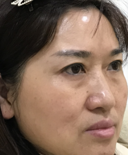 去眼袋手术