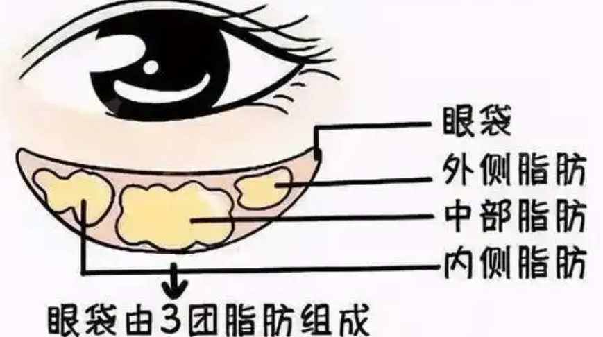 去眼袋手术