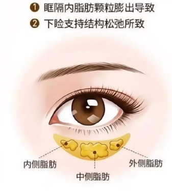 去眼袋手术