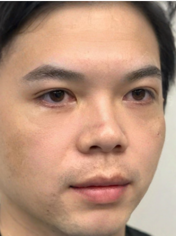 去眼袋手术