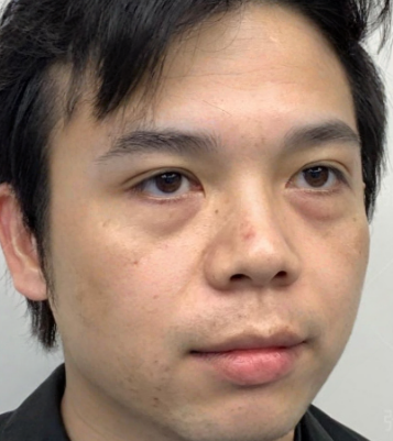 去眼袋手术