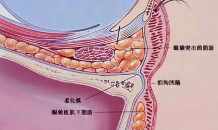 去眼袋手术