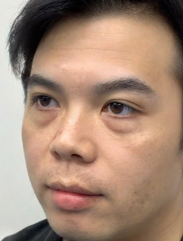 去眼袋手术