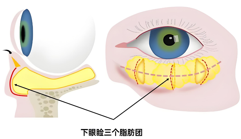 去眼袋手术