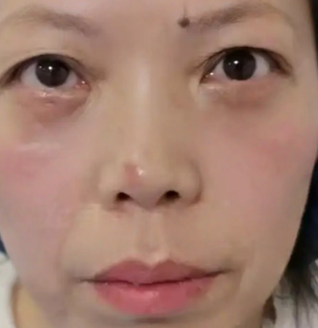去眼袋手术