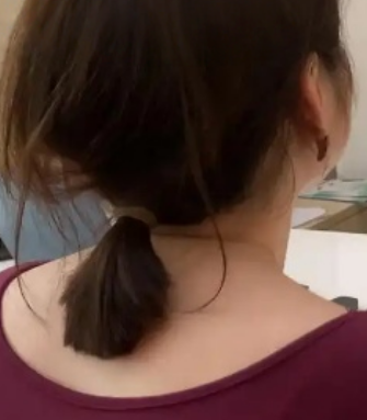 去眼袋手术