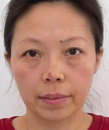 去眼袋手术