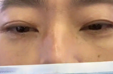 去眼袋手术