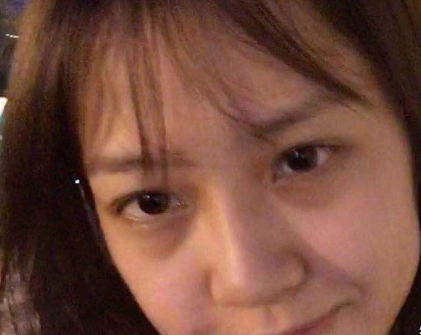 去眼袋手术