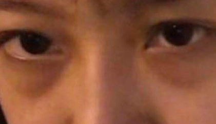 去眼袋手术