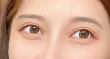 去眼袋手术