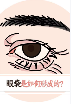 去眼袋手术