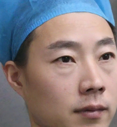 去眼袋手术