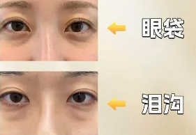 去眼袋手术