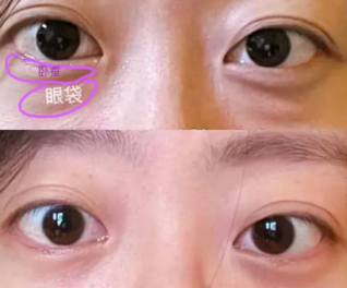 去眼袋手术