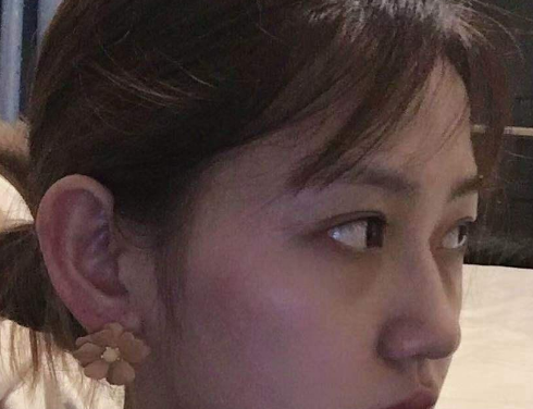 去眼袋手术