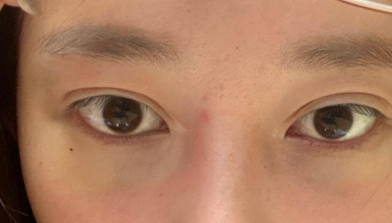去眼袋手术