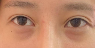 去眼袋手术