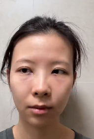 去眼袋手术