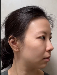 去眼袋手术