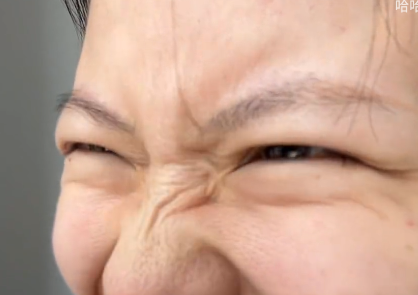 去眼袋手术